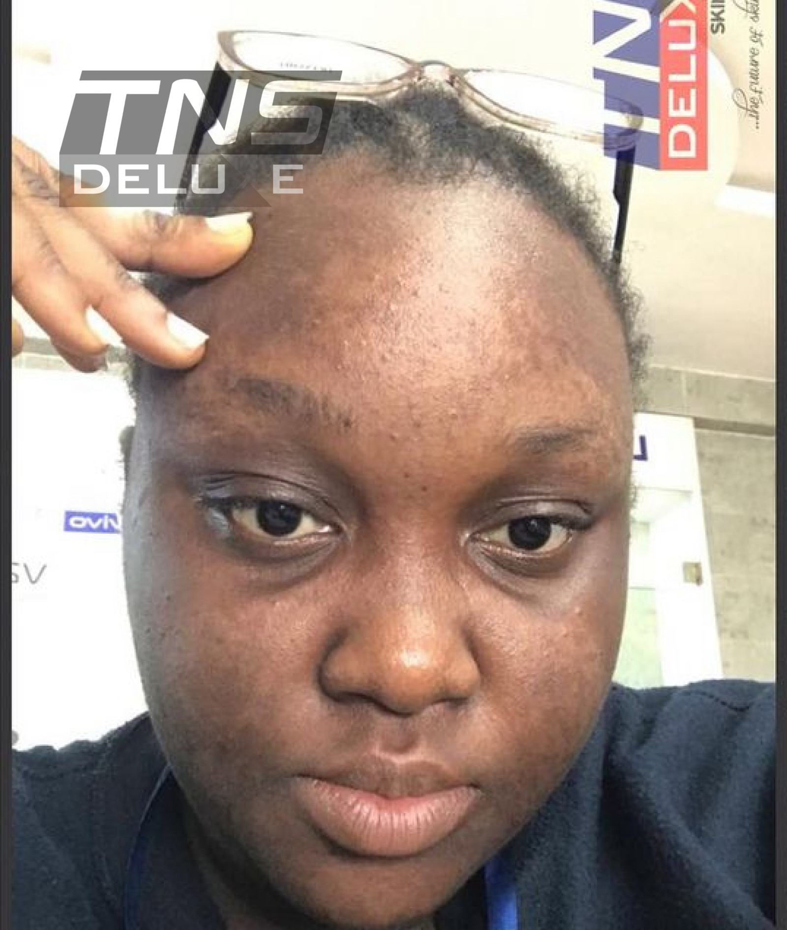 Image of a young lady with skin discoloration before using tns kin care products